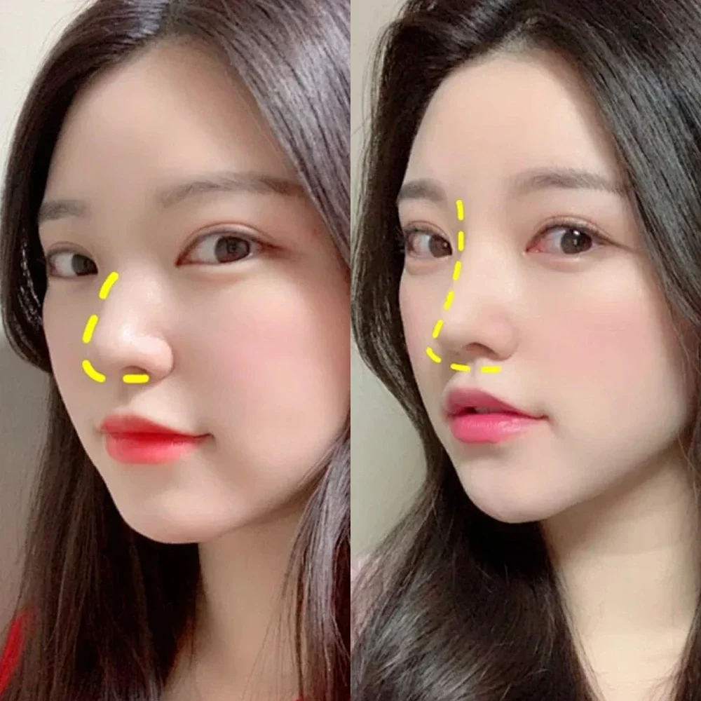 Breathable Thermoplastic Nose Lift & Corrector - Image 4