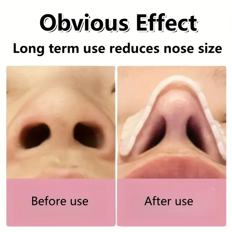 Breathable Thermoplastic Nose Lift & Corrector - Image 6
