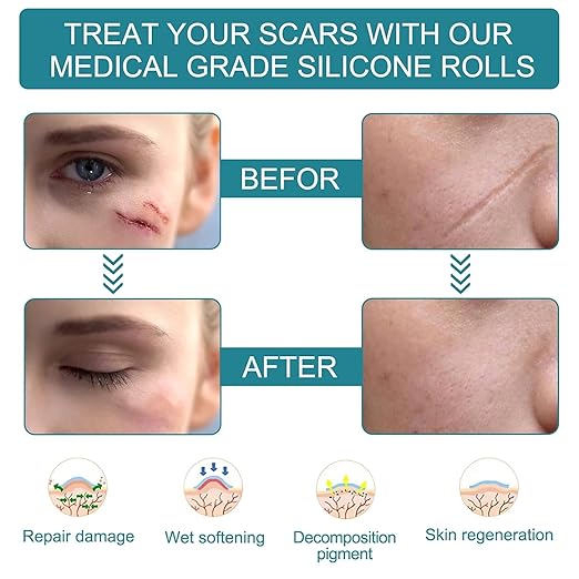 Reusable Medical-Grade Silicone Scar Strips Roll - Image 3