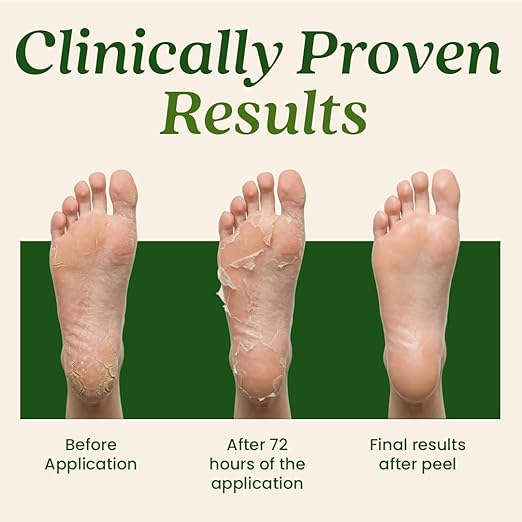 WildGlow Korean Peeling Foot Mask - Image 6